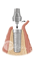 Dental Implants Ryde, Gladesville & Meadowbank | Putney Dental Care