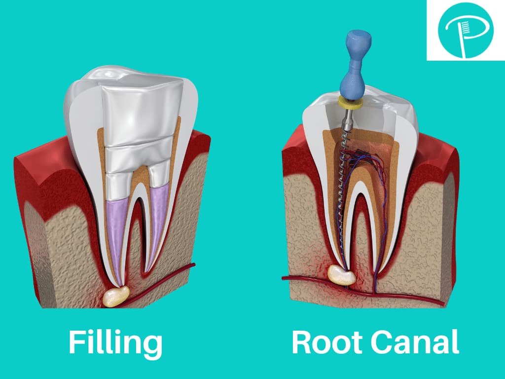 What Root Canal Looks Like  