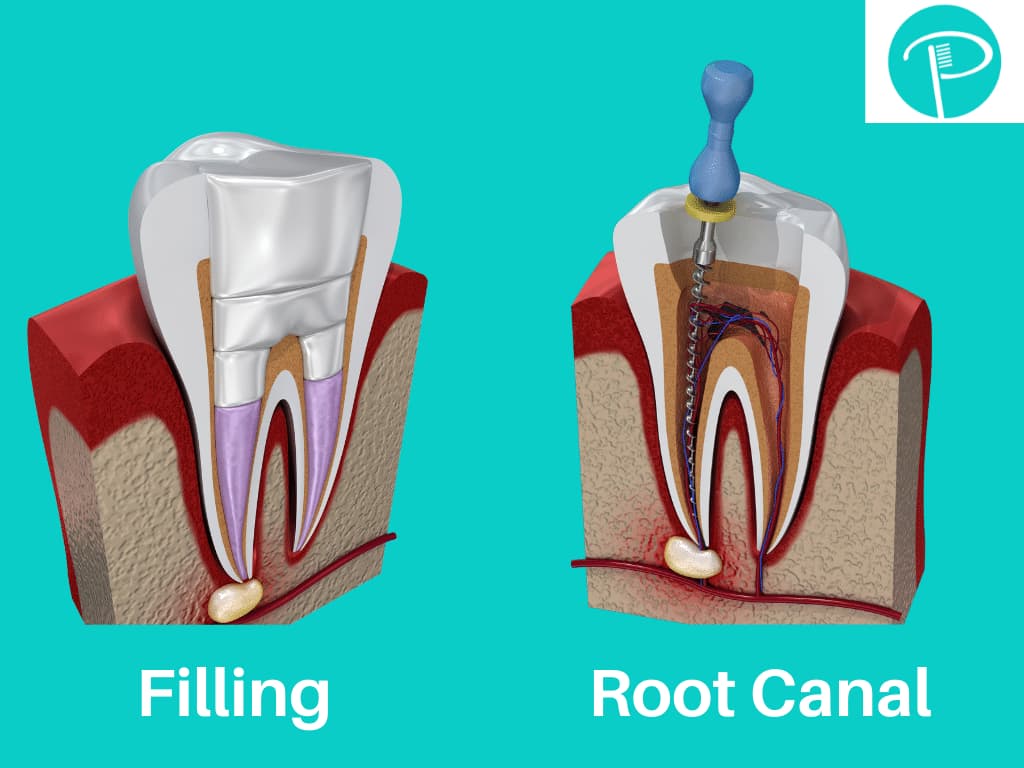 Pins In Tooth Fillings At Teresa Watson Blog