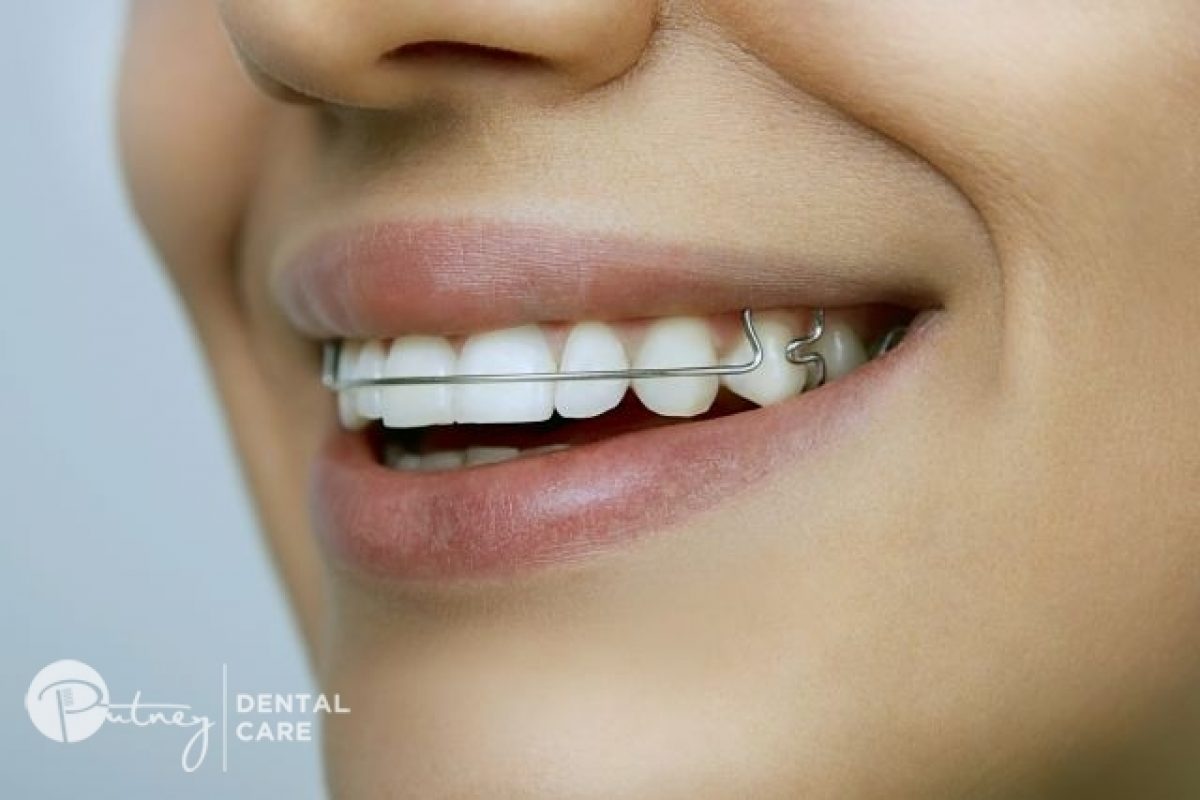 How To Take Care of Your Braces - Putney Dental Care