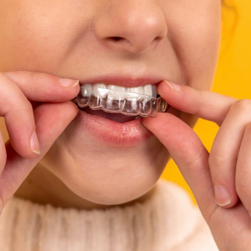 How To Take Care of Your Braces - Putney Dental Care